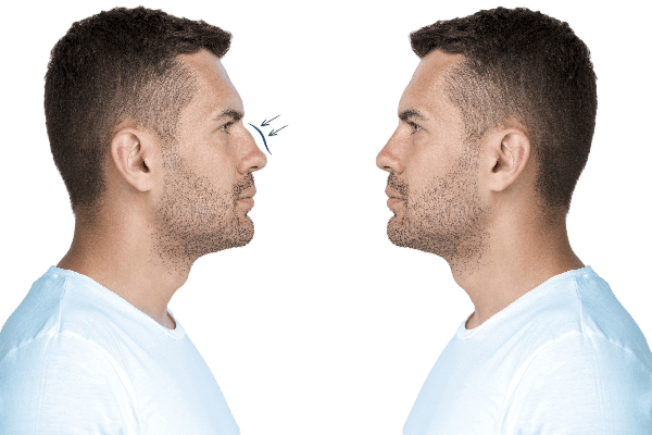 rhinoplasty for men